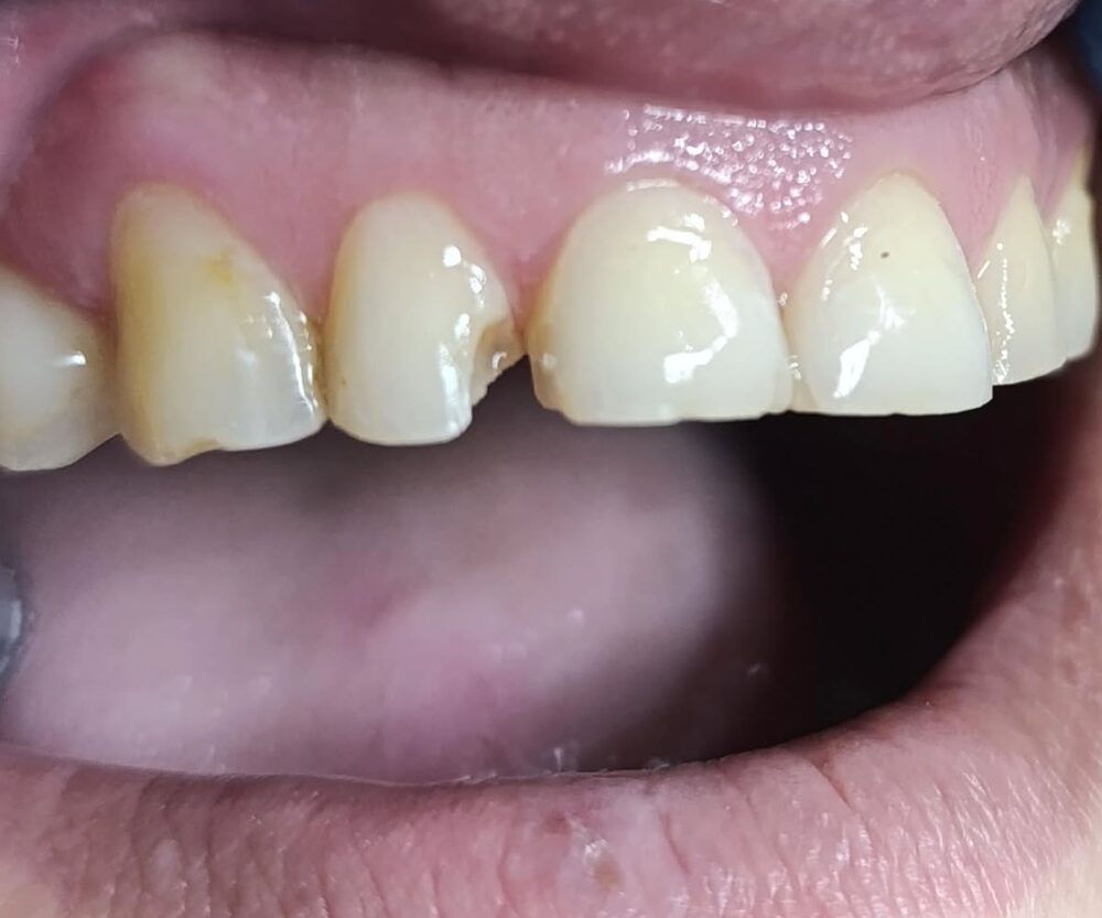 Antes: dentes anteriores desgastados e fraturados