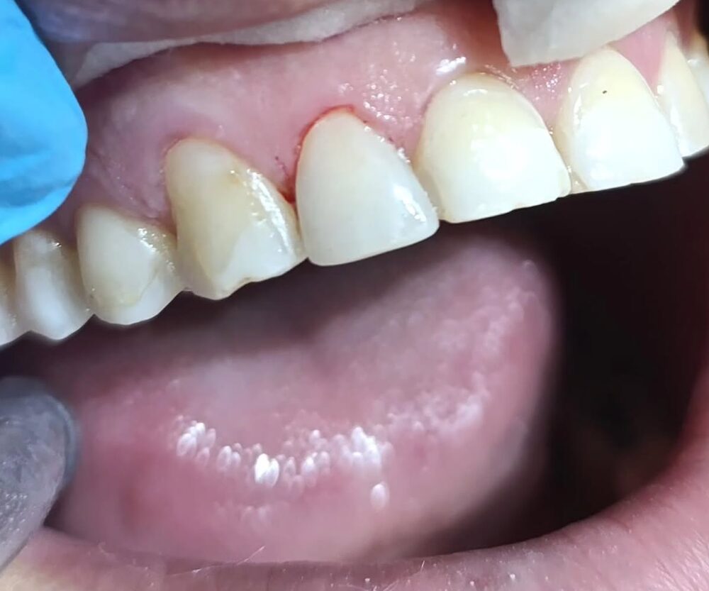 Depois: dentes restaurados